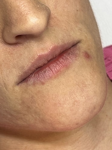 Bia antes do preenchimento labial